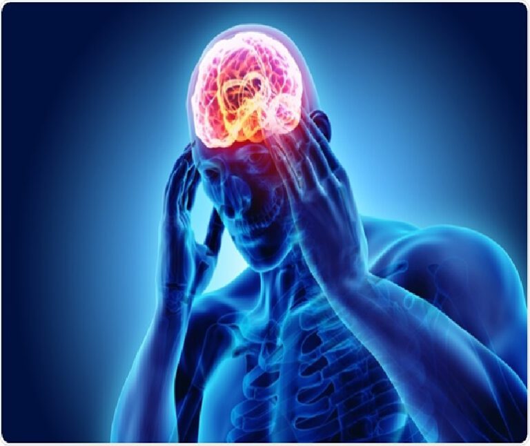 Migraine: its clinical presentation and management through “Swiftly, Safely and Sweetly” Mode of treatment – Homoeopathy